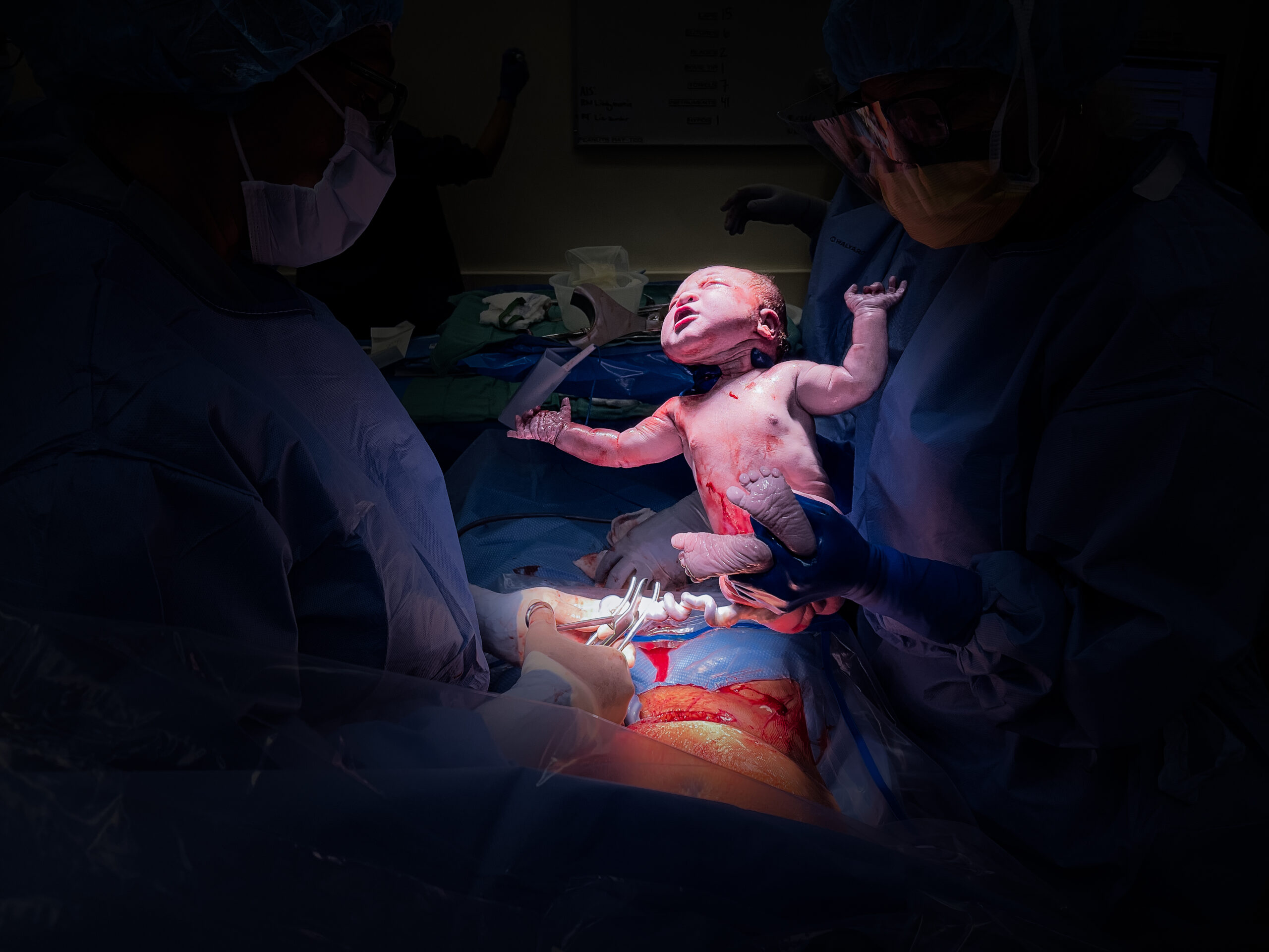 baby being born via cesarean in san diego california